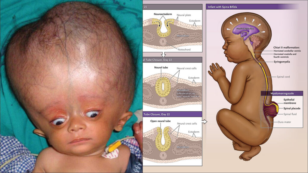 Understanding Spina Bifida And Hydrocephalus Bethany Tv 2588